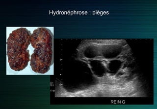 Hydronéphrose : pièges
 