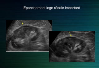 Hydronéphrose : pièges
 