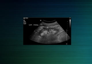 Hydronéphrose grade II
 