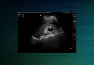 Epanchement loge rénale important
 