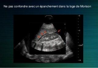 Ne pas confondre avec un épanchement dans la loge de Morison
 