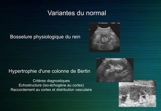 Variantes du normal
Bosselure physiologique du rein
Hypertrophie d'une colonne de Bertin
Critères diagnostiques
Echostructure (iso-échogène au cortex)
Raccordement au cortex et distribution vasculaire
 