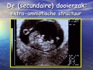 De (secundaire) dooierzak:De (secundaire) dooierzak:
extra-amniotische structuurextra-amniotische structuur
 