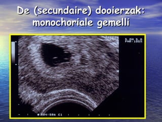 De (secundaire) dooierzak:De (secundaire) dooierzak:
monochoriale gemellimonochoriale gemelli
 