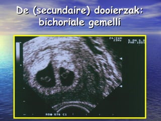 De (secundaire) dooierzak:De (secundaire) dooierzak:
bichoriale gemellibichoriale gemelli
 