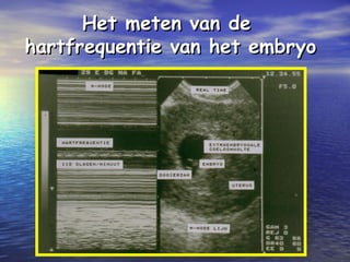 Het meten van deHet meten van de
hartfrequentie van het embryohartfrequentie van het embryo
 