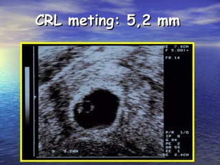 CRL meting: 5,2 mmCRL meting: 5,2 mm
 