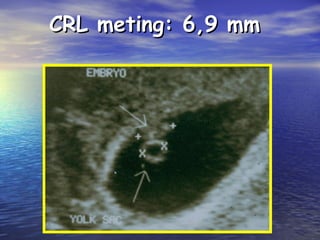 CRL meting: 6,9 mmCRL meting: 6,9 mm
 