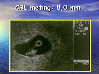 CRL meting: 8,0 mmCRL meting: 8,0 mm
 