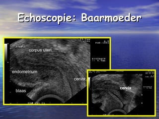 Echoscopie: BaarmoederEchoscopie: Baarmoeder
cervix
 