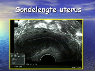 Sondelengte uterusSondelengte uterus
 