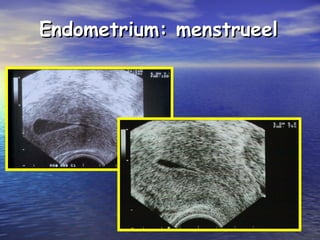 Endometrium: menstrueelEndometrium: menstrueel
 