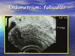 Endometrium: folliculairEndometrium: folliculair
 