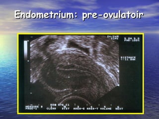 Endometrium: pre-ovulatoirEndometrium: pre-ovulatoir
 