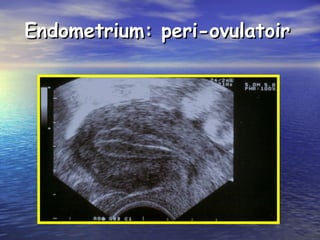 Endometrium: peri-ovulatoirEndometrium: peri-ovulatoir
 