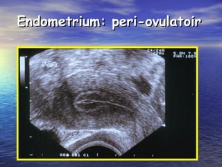 Endometrium: peri-ovulatoirEndometrium: peri-ovulatoir
 
