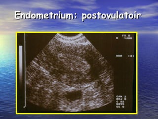 Endometrium: postovulatoirEndometrium: postovulatoir
 