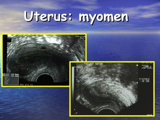 Uterus: myomenUterus: myomen
 