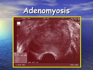 AdenomyosisAdenomyosis
 