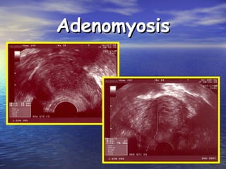 AdenomyosisAdenomyosis
 