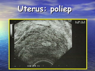 Uterus: poliepUterus: poliep
 