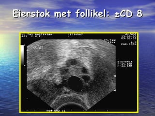 Eierstok met follikel: ±CD 8Eierstok met follikel: ±CD 8
 