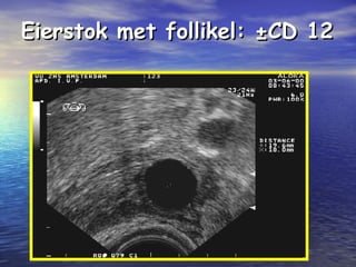 Eierstok met follikel: ±CD 12Eierstok met follikel: ±CD 12
 