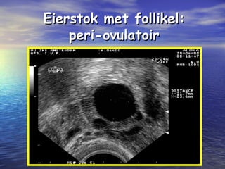 Eierstok met follikel:Eierstok met follikel:
peri-ovulatoirperi-ovulatoir
 