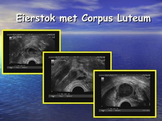 Eierstok met Corpus LuteumEierstok met Corpus Luteum
 
