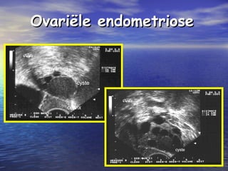 Ovariële endometrioseOvariële endometriose
 