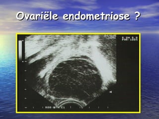 Ovariële endometriose ?Ovariële endometriose ?
 