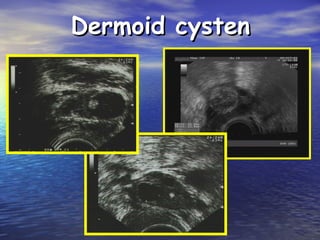Dermoid cystenDermoid cysten
 