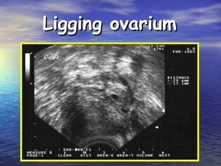 Ligging ovariumLigging ovarium
 