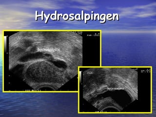 HydrosalpingenHydrosalpingen
 