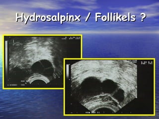 Hydrosalpinx / Follikels ?Hydrosalpinx / Follikels ?
 