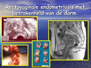 Rectovaginale endometriosis metRectovaginale endometriosis met
betrokenheid van de darmbetrokenheid van de darm
 