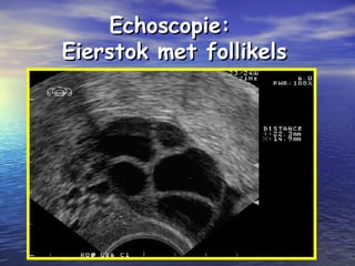 Echoscopie:Echoscopie:
Eierstok met follikelsEierstok met follikels
 