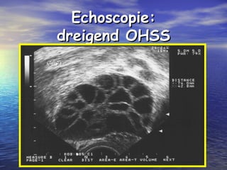 Echoscopie:Echoscopie:
dreigend OHSSdreigend OHSS
 