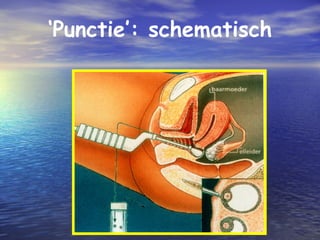 ‘Punctie’: schematisch
 