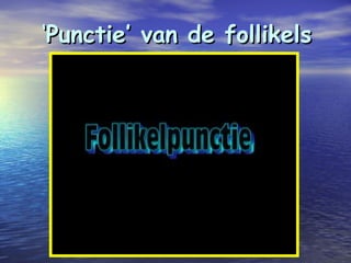 ‘‘Punctie’ van de follikelsPunctie’ van de follikels
 