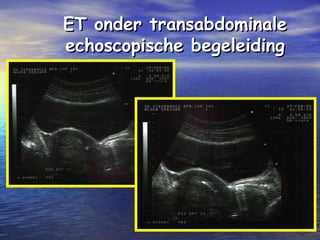 ET onder transabdominaleET onder transabdominale
echoscopische begeleidingechoscopische begeleiding
 