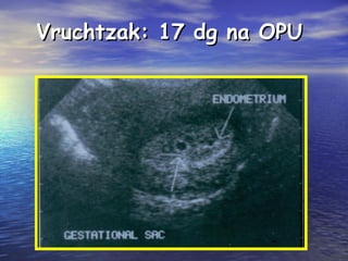Vruchtzak: 17 dg na OPUVruchtzak: 17 dg na OPU
 