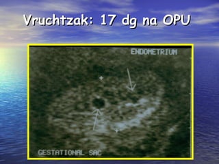 Vruchtzak: 17 dg na OPUVruchtzak: 17 dg na OPU
 