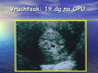 Vruchtzak: 19 dg na OPUVruchtzak: 19 dg na OPU
 