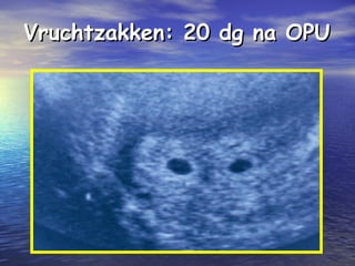 Vruchtzakken: 20 dg na OPUVruchtzakken: 20 dg na OPU
 