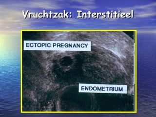 Vruchtzak: InterstitieelVruchtzak: Interstitieel
 