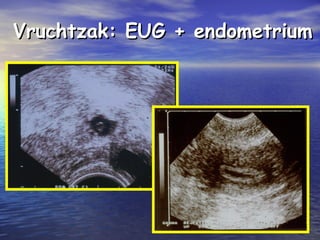 Vruchtzak: EUG + endometriumVruchtzak: EUG + endometrium
 