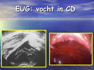 EUG: vocht in CDEUG: vocht in CD
 