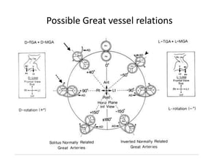 Possible Great vessel relations
 