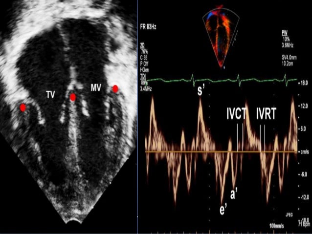 Boston Z-Score Pediatric Echo | Fetal echocardiogram Z Score Calculator ...